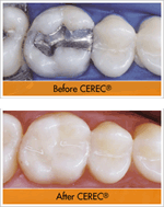 cerec-img-right.gif