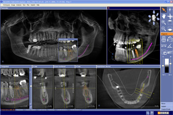 pi_sirona_galileos_3d_ist_m.gif