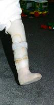 First Prosthesis